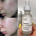 Niacinamide 10% + Zinc 1% Face Serum – Oil Control, Acne Care & Pore Minimizing Formula | 30ml